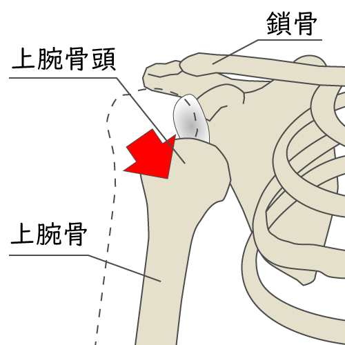 肩を脱臼したイメージ