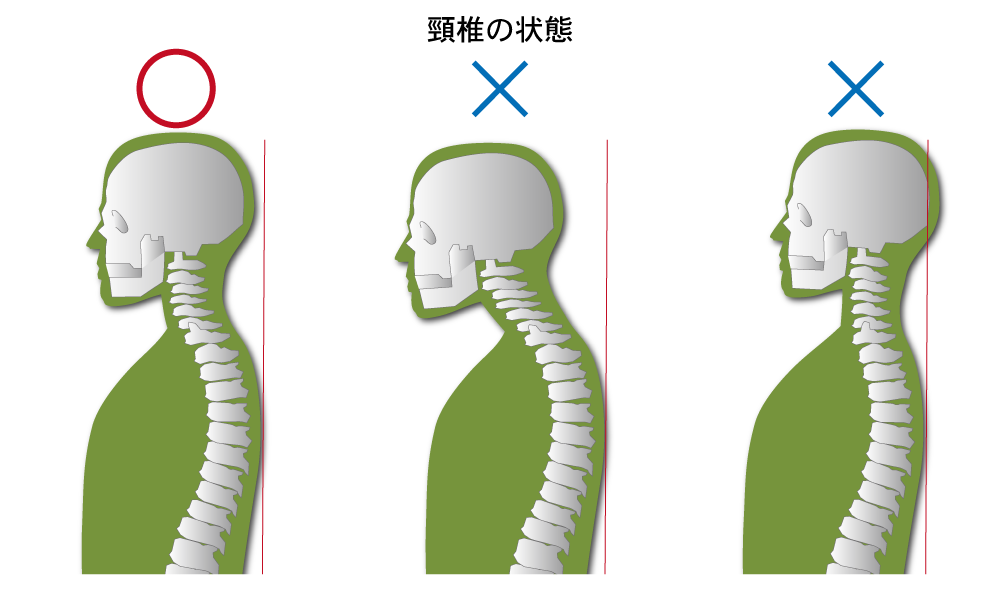 頸椎の正常な状態、異常な状態２例 解説図