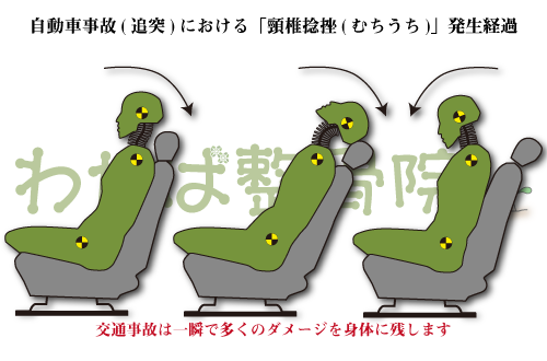 自動車事故（追突）における「頸椎捻挫（むちうち）」発生経過説明図